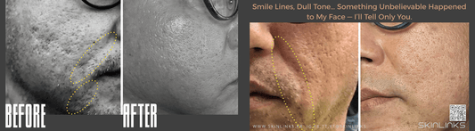 Smile Lines, Dull Tone… Something Unbelievable Happened to My Face — I’ll Tell Only You. - Korean Ultrasound Beauty Devices | Estella Official